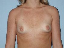 Breast Augmentation Before Photo by Raymond Mockler, MD; Panama City, FL - Case 8476
