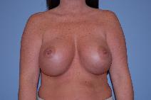 Breast Augmentation After Photo by Raymond Mockler, MD; Panama City, FL - Case 8477