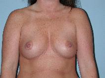 Breast Augmentation Before Photo by Raymond Mockler, MD; Panama City, FL - Case 8477