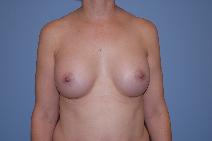 Breast Augmentation After Photo by Raymond Mockler, MD; Panama City, FL - Case 8478