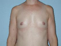 Breast Augmentation Before Photo by Raymond Mockler, MD; Panama City, FL - Case 8478