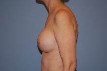 Breast Augmentation After Photo by Raymond Mockler, MD; Panama City, FL - Case 8478