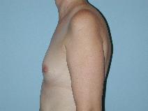 Breast Augmentation Before Photo by Raymond Mockler, MD; Panama City, FL - Case 8478