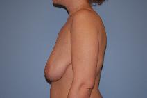 Breast Augmentation Before Photo by Raymond Mockler, MD; Panama City, FL - Case 8480