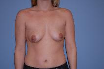 Breast Augmentation Before Photo by Raymond Mockler, MD; Panama City, FL - Case 8481