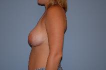 Breast Augmentation After Photo by Raymond Mockler, MD; Panama City, FL - Case 8481