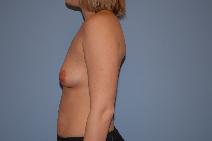 Breast Augmentation Before Photo by Raymond Mockler, MD; Panama City, FL - Case 8481