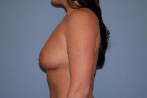 Breast Augmentation Before Photo by Raymond Mockler, MD; Panama City, FL - Case 8487