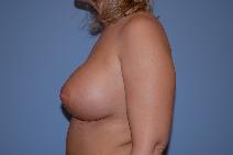 Breast Augmentation After Photo by Raymond Mockler, MD; Panama City, FL - Case 8488