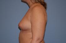 Breast Augmentation Before Photo by Raymond Mockler, MD; Panama City, FL - Case 8488