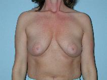 Breast Augmentation Before Photo by Raymond Mockler, MD; Panama City, FL - Case 8489