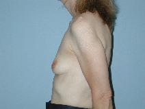 Breast Augmentation Before Photo by Raymond Mockler, MD; Panama City, FL - Case 8492