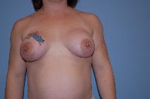 Breast Augmentation After Photo by Raymond Mockler, MD; Panama City, FL - Case 8493