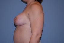 Breast Augmentation After Photo by Raymond Mockler, MD; Panama City, FL - Case 8493