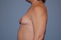 Breast Augmentation Before Photo by Raymond Mockler, MD; Panama City, FL - Case 8493