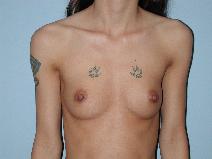 Breast Augmentation Before Photo by Raymond Mockler, MD; Panama City, FL - Case 8495