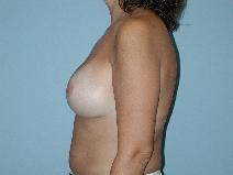 Breast Augmentation After Photo by Raymond Mockler, MD; Panama City, FL - Case 8496