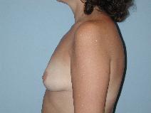 Breast Augmentation Before Photo by Raymond Mockler, MD; Panama City, FL - Case 8496