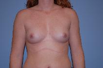 Breast Augmentation Before Photo by Raymond Mockler, MD; Panama City, FL - Case 8497