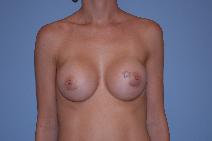 Breast Augmentation After Photo by Raymond Mockler, MD; Panama City, FL - Case 8498