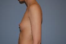 Breast Augmentation Before Photo by Raymond Mockler, MD; Panama City, FL - Case 8498