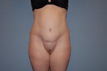 Tummy Tuck After Photo by Raymond Mockler, MD; Panama City, FL - Case 8537