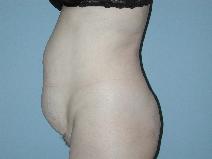 Tummy Tuck Before Photo by Raymond Mockler, MD; Panama City, FL - Case 8537