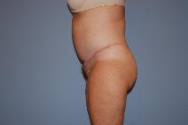 Tummy Tuck After Photo by Raymond Mockler, MD; Panama City, FL - Case 8543