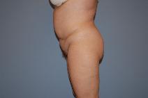 Tummy Tuck Before Photo by Raymond Mockler, MD; Panama City, FL - Case 8543