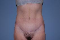 Tummy Tuck After Photo by Raymond Mockler, MD; Panama City, FL - Case 8546
