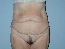 Tummy Tuck Before Photo by Raymond Mockler, MD; Panama City, FL - Case 8546