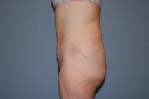 Tummy Tuck After Photo by Raymond Mockler, MD; Panama City, FL - Case 8546