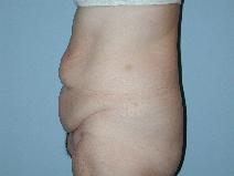 Tummy Tuck Before Photo by Raymond Mockler, MD; Panama City, FL - Case 8546