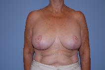 Breast Reduction After Photo by Raymond Mockler, MD; Panama City, FL - Case 8556