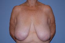 Breast Reduction Before Photo by Raymond Mockler, MD; Panama City, FL - Case 8556