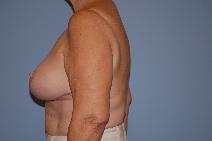 Breast Reduction After Photo by Raymond Mockler, MD; Panama City, FL - Case 8556
