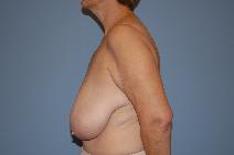 Breast Reduction Before Photo by Raymond Mockler, MD; Panama City, FL - Case 8556
