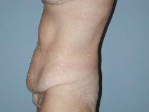 Tummy Tuck After Photo by Raymond Mockler, MD; Panama City, FL - Case 9444