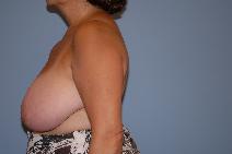 Breast Reduction Before Photo by Raymond Mockler, MD; Panama City, FL - Case 9447