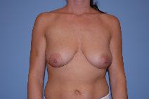 Breast Lift Before Photo by Raymond Mockler, MD; Panama City, FL - Case 9448