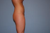 Liposuction After Photo by Raymond Mockler, MD; Panama City, FL - Case 9449