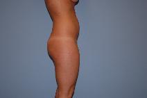 Liposuction Before Photo by Raymond Mockler, MD; Panama City, FL - Case 9449