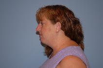 Liposuction After Photo by Raymond Mockler, MD; Panama City, FL - Case 9454