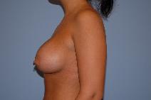 Breast Augmentation After Photo by Raymond Mockler, MD; Panama City, FL - Case 9455
