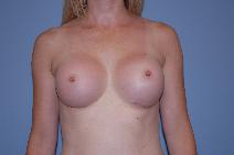 Breast Augmentation After Photo by Raymond Mockler, MD; Panama City, FL - Case 9457