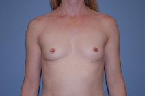 Breast Augmentation Before Photo by Raymond Mockler, MD; Panama City, FL - Case 9457