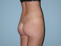 Liposuction After Photo by Raymond Mockler, MD; Panama City, FL - Case 9479