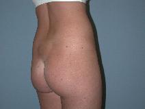 Liposuction Before Photo by Raymond Mockler, MD; Panama City, FL - Case 9479