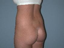Liposuction Before Photo by Raymond Mockler, MD; Panama City, FL - Case 9479