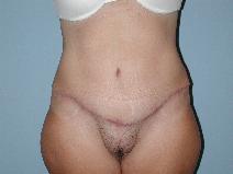 Tummy Tuck After Photo by Raymond Mockler, MD; Panama City, FL - Case 9480